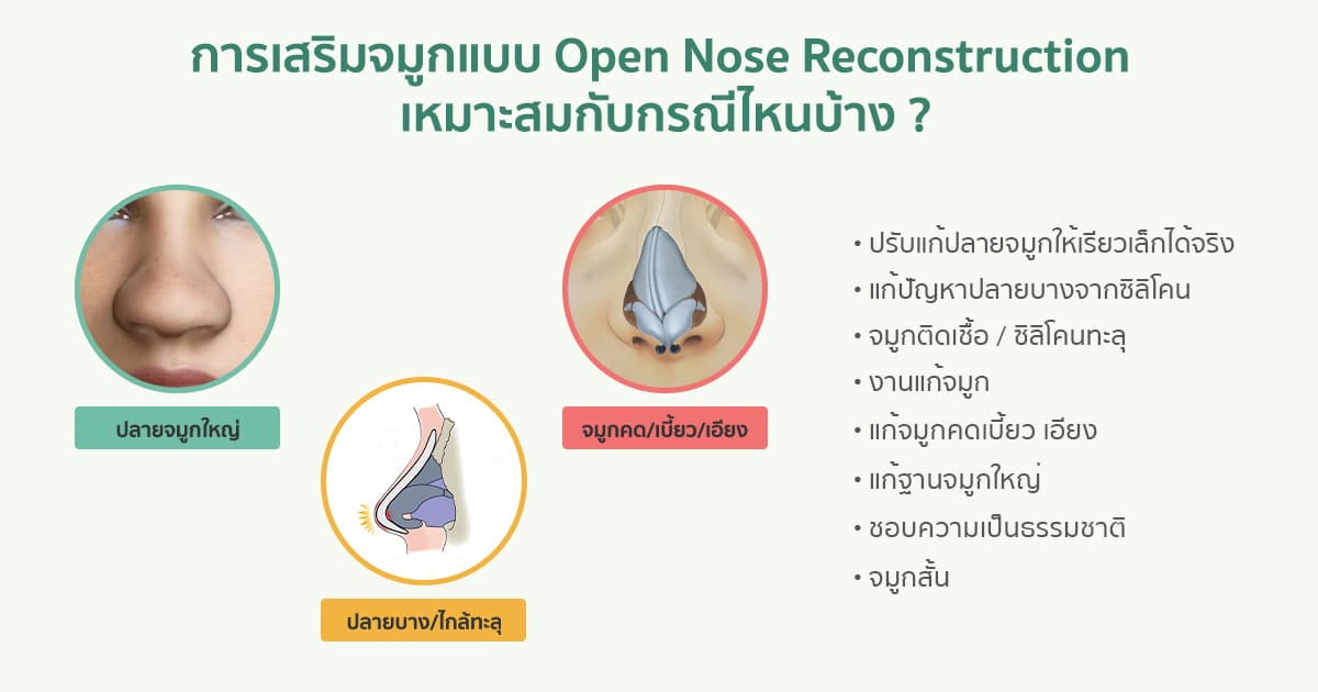 การเสริมจมูกแบบ Open Nose Reconstruction เหมาะสมกับกรณีไหนบ้าง ?