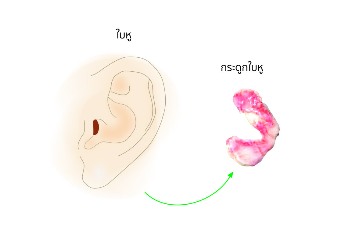 กระดูกอ่อนใบหู VS เยื่อไขมันอ่อนหลังหู VS เยื่อเทียม ความเหมือนที่แตกต่าง อยากรองปลายจมูกเลือกแบบไหนดี ?