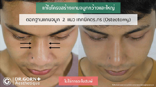 Nose-Reconstruction