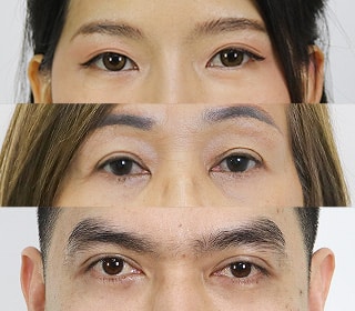 Eyelid-Surgery-4