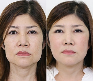 Facial-rejuvenation-3