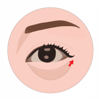 icon eyebag reduction