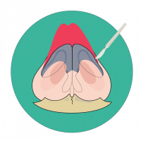 icon open rhinoplasty